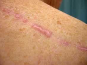 Hypertrophic Scars And Keloids A Complete Overview DermNet