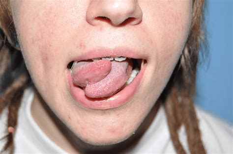 Tongue Splitting Surgery Information Cost Pictures