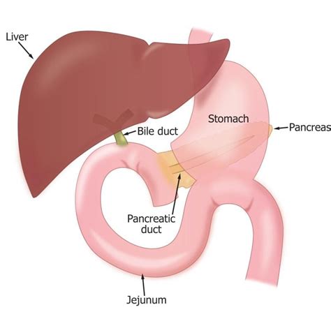 Pancreatic Head Resection Whipple Procedure Liver And Pancreas My Xxx