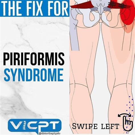 What Is Piriformis Syndrome And What To Do About It Kinetic Images And Photos Finder