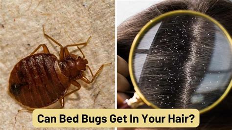 Can Bed Bugs Get In Your Hair