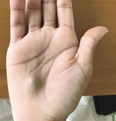 Mans Hand Lump Found After Dental Procedure Turns Out To Be Sign Of Serious Heart Infection