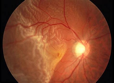 descolamento de retina promacula dr nelson chamma