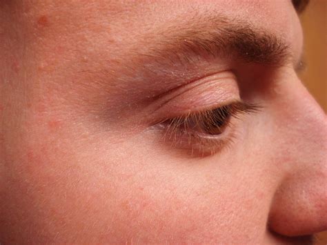 Virtual Grand Rounds In Dermatology 20 Unusual Eyelid Dermatitis