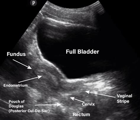 gynecology pelvic ultrasound made easy step by step guide ultrasound medical ultrasound