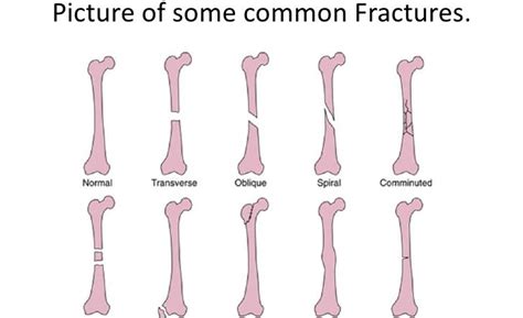 Fishbone diagram or ishikawa diagram is a modern quality management tool that explains the cause and effect relationship for any quality issue that has arisen or that may arise. Broken Bones Types of Fractures and Bone Structure Anatomy