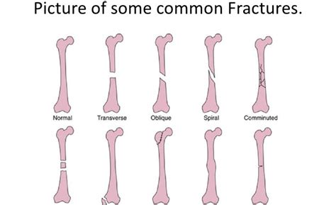 It's the progenitor of frameworks like ember, angular, even meteor. Broken Bones Types of Fractures and Bone Structure Anatomy