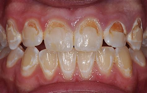 Temporary Tooth Filling Front Teeth Dental Photos Before After Photos
