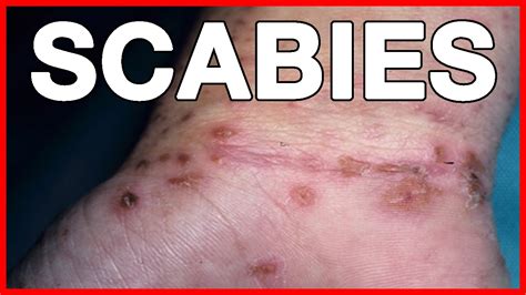 Scabies Causes Symptoms And Treatment Youtube Vrogue Co