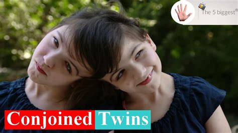 Conjoined Twins Top 10 Facts You 🅳🅾🅽🆃 Need To Know ~ Body Bizarre