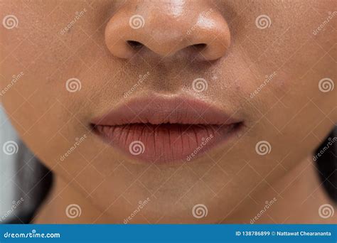 Body Part Mouth Lip Acne Wart Skin Close Up Woman Stock Image Image