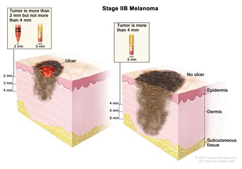 A Diagram Illustrating Stage Ii Melanomas Melanoma Staging Ohsu
