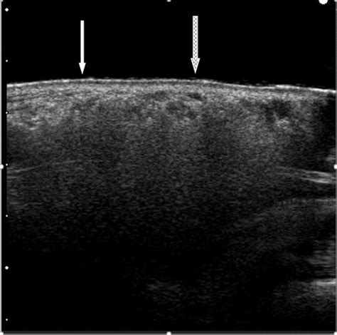 Sonographic Aspect Of Patients Upper Lip Showing The Typical Snowstorm