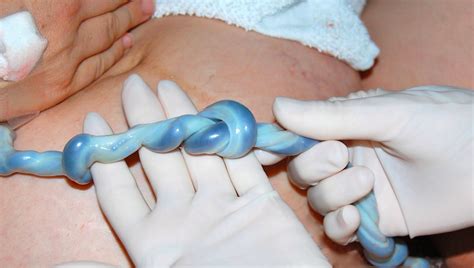 How to bathe a newborn. Umbilical Cord Knots: Causes, Signs and Treatment | Med ...
