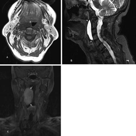 A Flexible Fiberoptic Laryngoscopy View Of The Retropharyngeal Mass