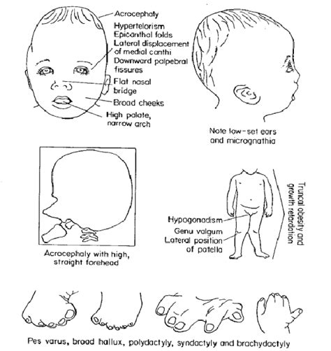 Epicanthal folds are normal in asians like in native americans and in korean population. Flat Nasal Bridge And Epicanthal Folds / Chromosomal ...