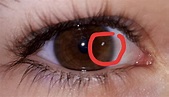 Weisser Punkt im Auge was tun? (Augen, weißer Punkt)