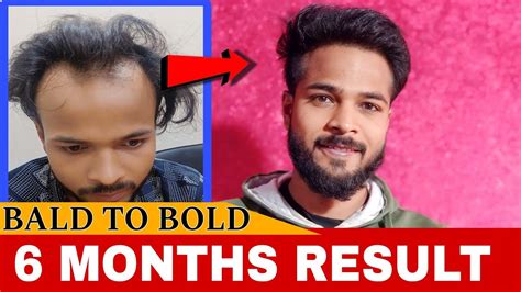 Months Of My Hair Transplant Journey Amazing Result Hairtransplant Hairgrowth Trending