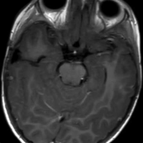 Pdf Incidental Choroid Plexus Papilloma In A Child A Difficult Decision