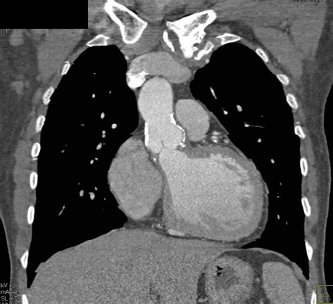 Calcification Of The Ascending Aorta Without Dissection Cardiac Case