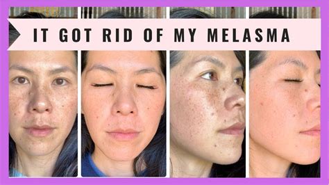 Does Musely Really Work Sun Care One Month Progress Using Musely Spot