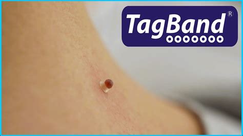 tagband skin tag remover youtube