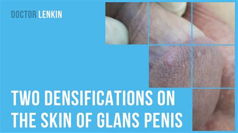 😕 Two Densifications On The Skin Of Glans Penis After Sex Youtube