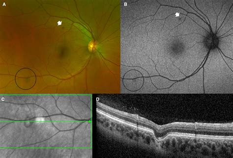 Primary And Secondary Focal Choroidal Excavation Morphologic Phenotypes