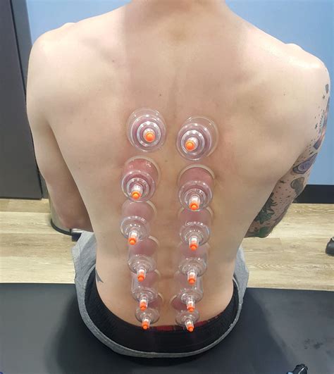 What Is Cupping A Team Performance And Chiropractic Llc