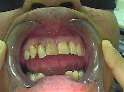 Palatal Cyst Dr Galil Clinical Cases