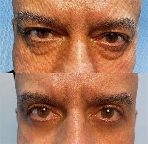 Patient 55495894 Blepharoplasty Eyelid Surgery Before And After