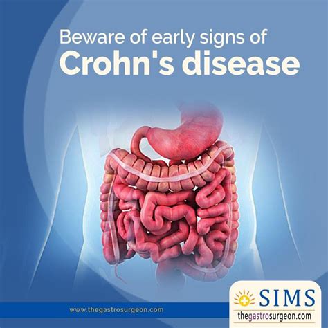 Pin On Crohns Disease