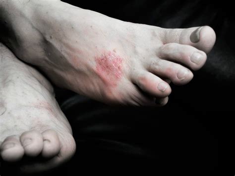 Treating A Rash On Feet Thriftyfun