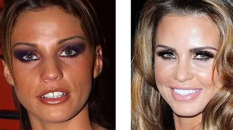 celebrity teeth before and after