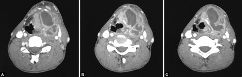 Laryngeal Carcinoma Masquerading As Tubercular Deep Neck Abscess