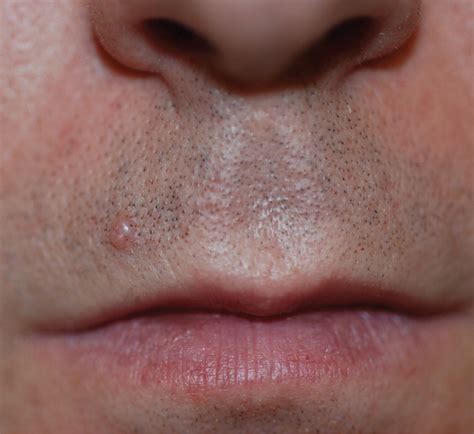 Skin Colored Dome Shaped Papule On The Upper Lip Aafp