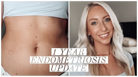 My Endometriosis Story 1 Year Update And How Im Curing My Endo Youtube