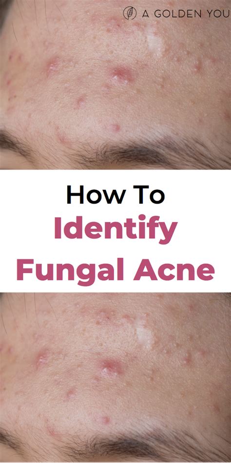 Fungal acne is usually resistant to traditional acne treatments, but can be successfully reduced with the right body washes and oral medication. How To Identify Fungal Acne. Wondering if you have fungal ...