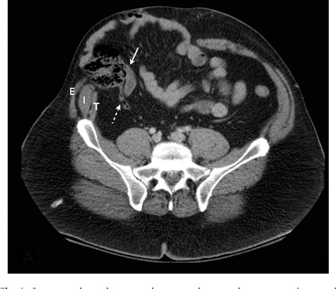 Figure 1 From Abdominal Wall Hernia And Aortic Injury Secondary To