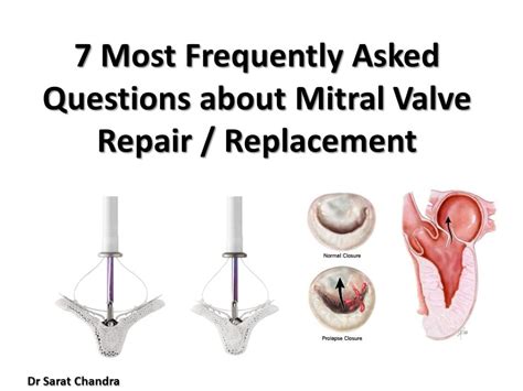Mitral Valve Repair Surgery Cost In Hyderabad Dr Sarat