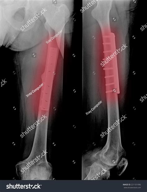 Film Leg Aplateral Show Fracture Shaft Stock Photo 221101996 Shutterstock