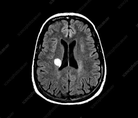 Magnetic resonance imaging (mri) for multiple sclerosis. Multiple sclerosis, MRI scan - Stock Image - C033/7392 ...