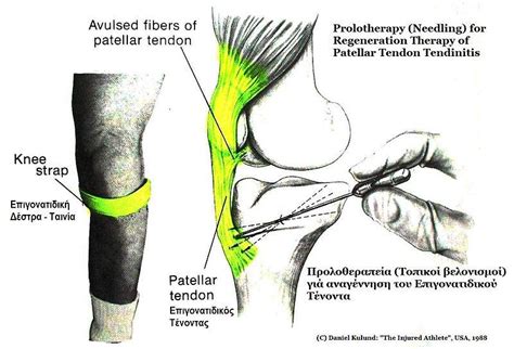 Knee Cap Pain And Types Of Kneecap Injury Healthhype Com