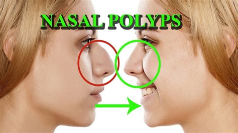 Nasal Polyps Signs Symptoms Causes And Treatment Arogyam Allergy