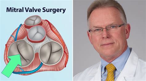 Mitral Valve Surgery What Should Patients Know Interview With Dr
