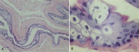 A Low And B High Power Histological Figures Of Steatocystoma