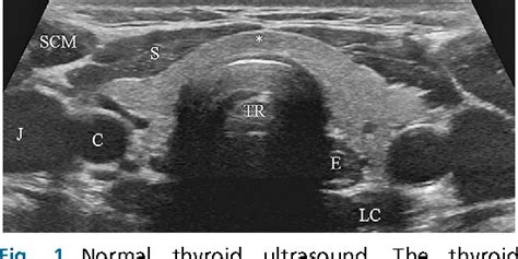 Pdf Thyroid Ultrasound Part 1 Technique And Diffuse Disease
