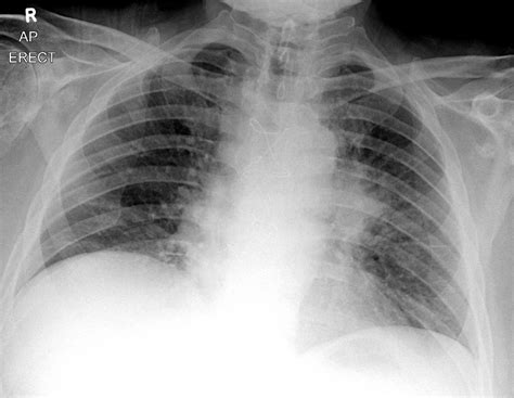 Small Cell Carcinoma Of The Lung Chest X Ray Wikidoc