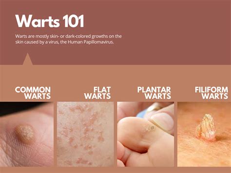 The Derma Corner The 101 On Warts Potential Treatments And How To