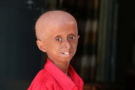 Indian Boy Who Suffers From Progeria Looks Like Pensioner Daily Mail